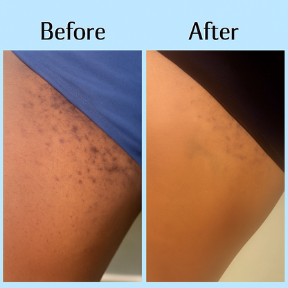 Silkswipe™ Ingrown Hair Treatment