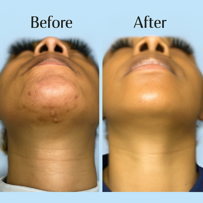 Silkswipe™ Ingrown Hair Treatment